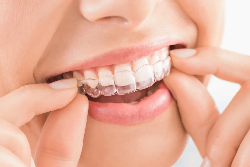 Aparelho ortodôntico Invisalign